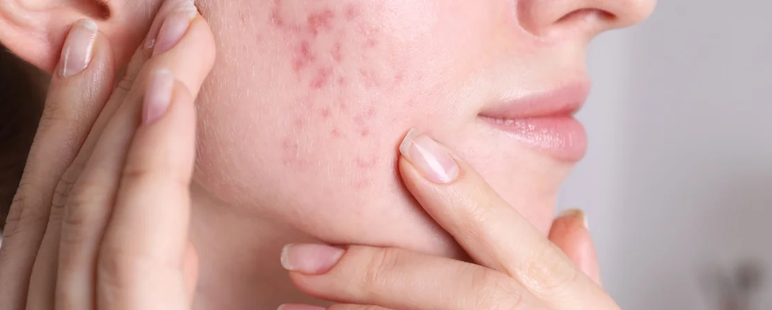 Acne Therapy in Brampton at Derma Capital Laser Clinic