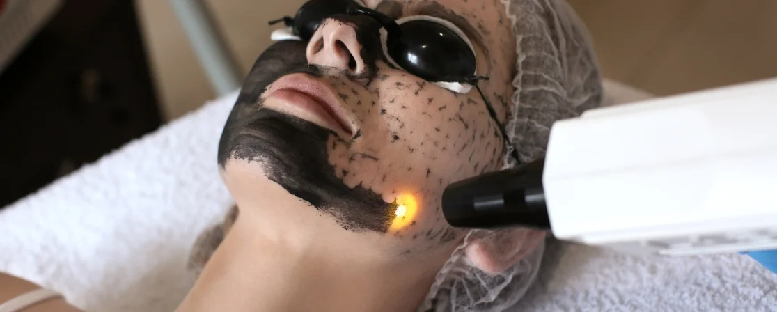 Carbon Laser Peel Skin Rejuvenation in Brampton at Derma Capital Laser Clinic