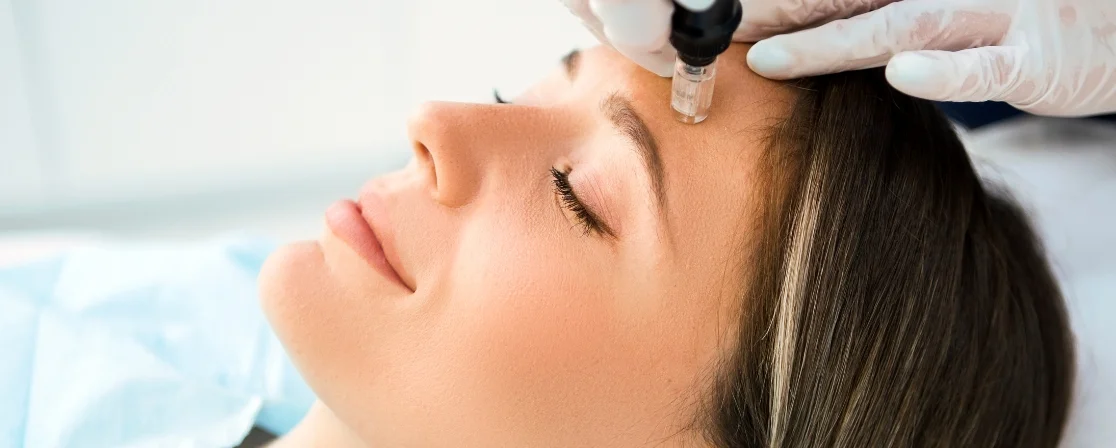 Micro-Needling in Brampton at Derma Capital Laser Clinic