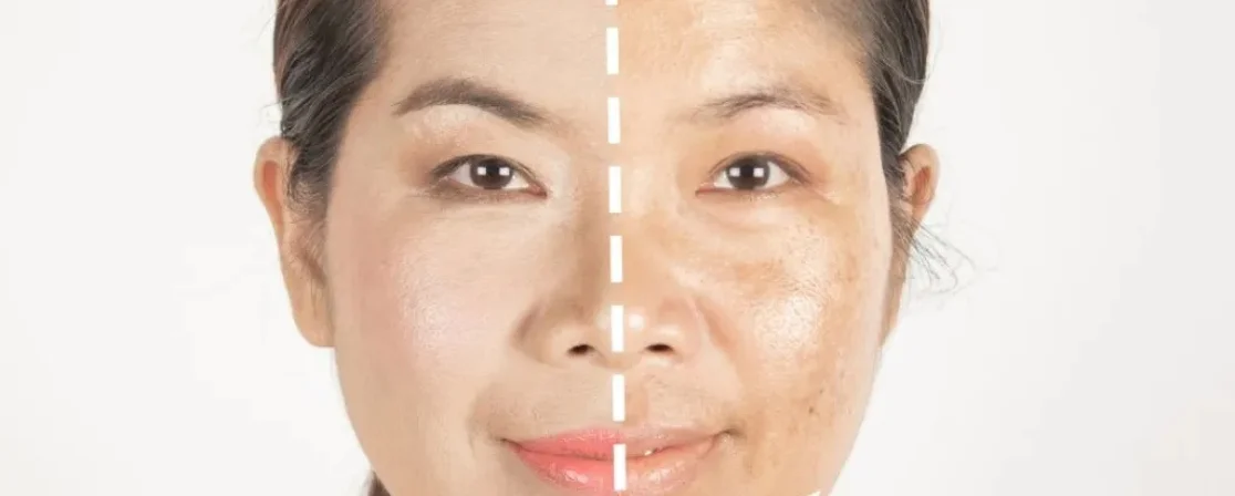 Pigment Lesion Removal in Brampton at Derma Capital Laser Clinic
