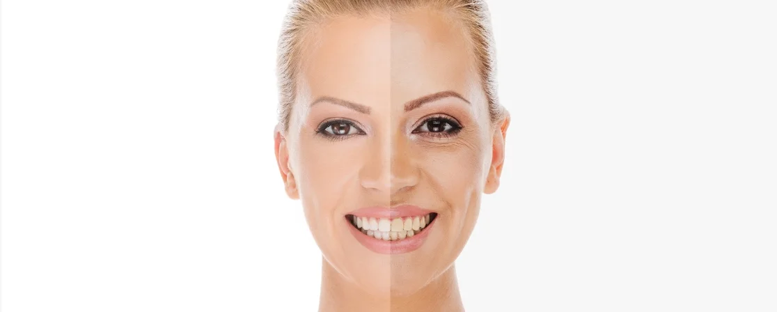 Acne Scar Removal in Brampton at Derma Capital Laser Clinic