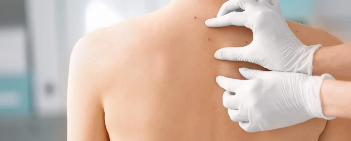Skin Tag Removal in Brampton at Derma Capital Laser Clinic