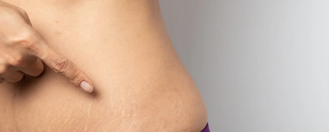 Stretch Marks Treatment in Brampton at Derma Capital Laser Clinic