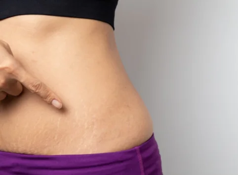 Stretch Mark Reduction