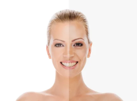 Acne Scar Removal