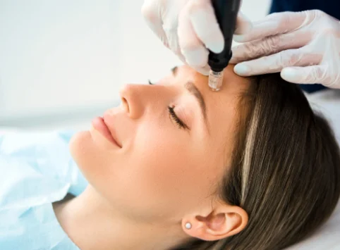 Microneedling