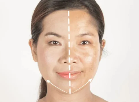 Pigment Lesion Removal