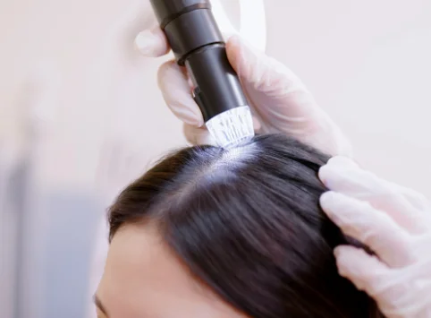 Scalp Laser Therapy
