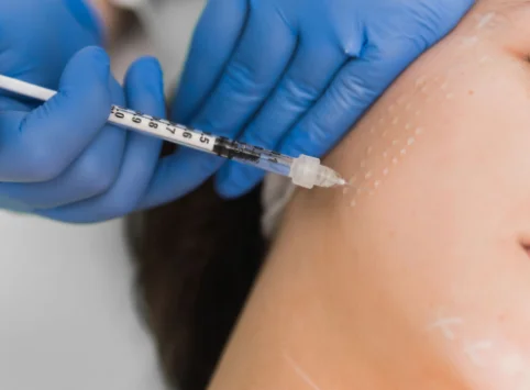 Vitamin Mesotherapy